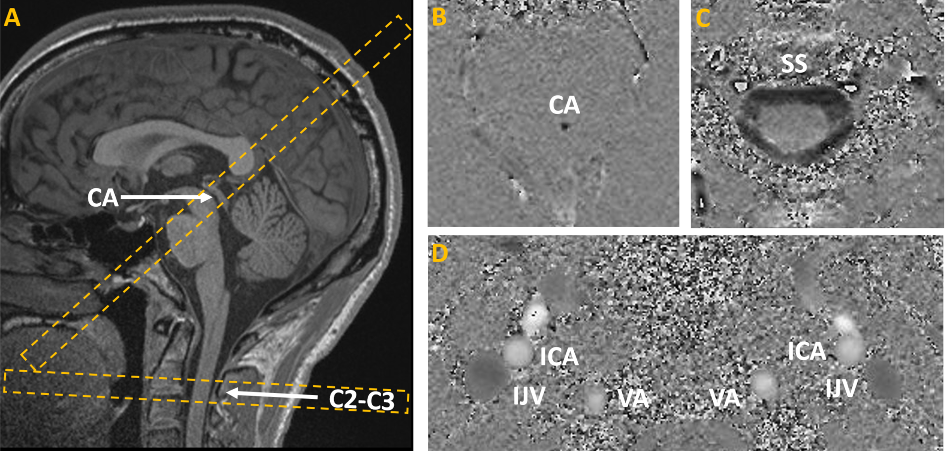 Assessing Testretest Reliability Of Phase Contrast Mri For Measuring Cerebrospinal Fluid And